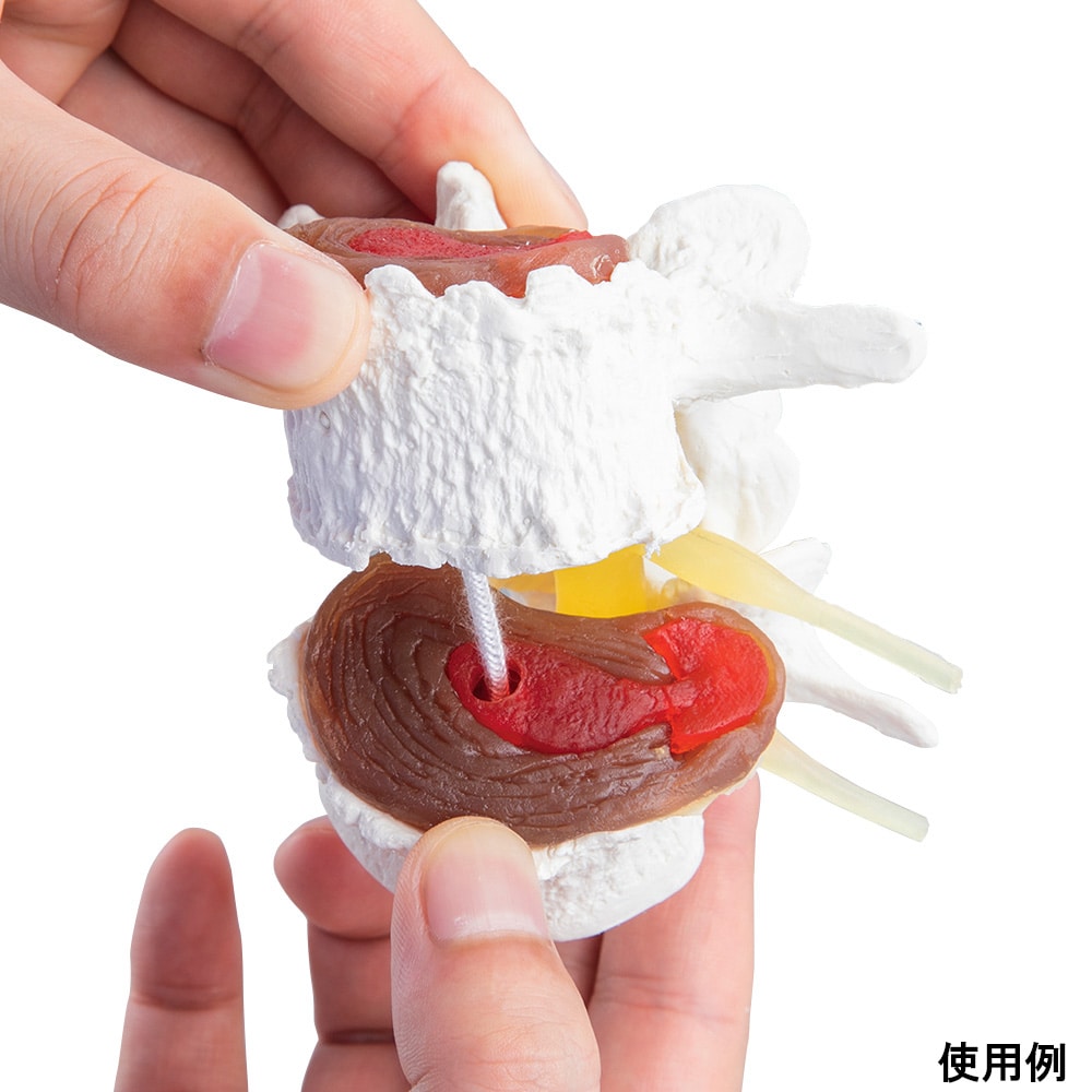 Erler-Zimmer 椎間板変性症モデル7577 1個 (ご注文単位1個) 【直送品】
