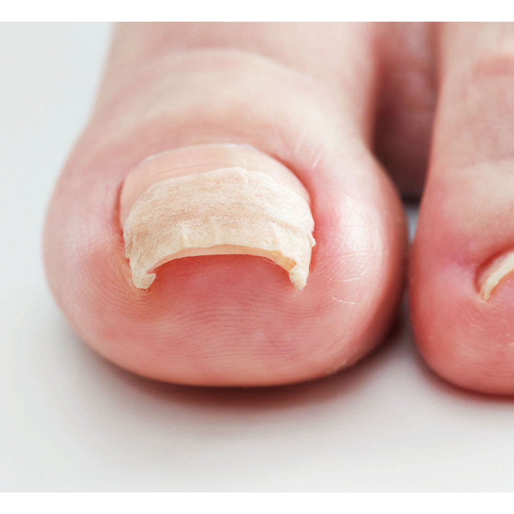 コジット 巻爪ケア プロサポートシール 医療用テープ 80枚入 1パック(ご注文単位1パック)【直送品】