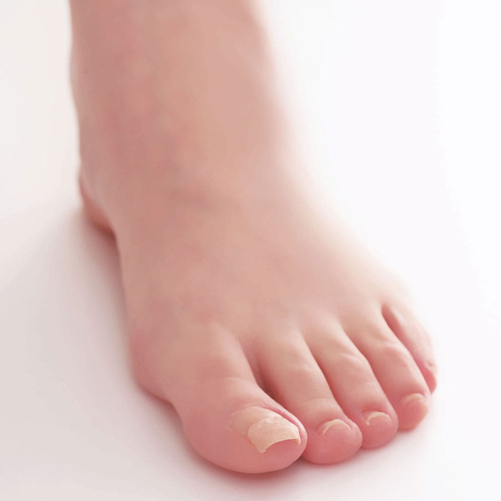 コジット 巻爪ケア プロサポートシール 医療用テープ 80枚入 1パック(ご注文単位1パック)【直送品】